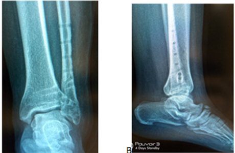 Figure 2: ** Tibiotalar osteoarthritis after plate + screw removal at 3 years.