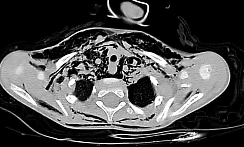 Figure 3: Thoracic computed tomography - axial slice: significant thoracic emphysema. air entrapment in the left pulmonary hemfield, significant pneumo-mediastinum, pneumopericardium.