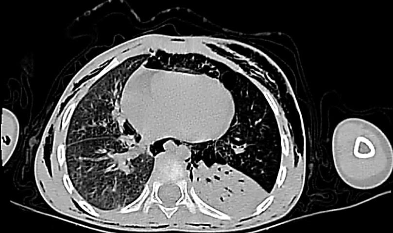 Figure 4: Chest CT scan - axial slice: air entrapment in the large left pulmonary hemfield, pneumo-mediastinum and pneumopericardium with condensation of the left lower lobe.