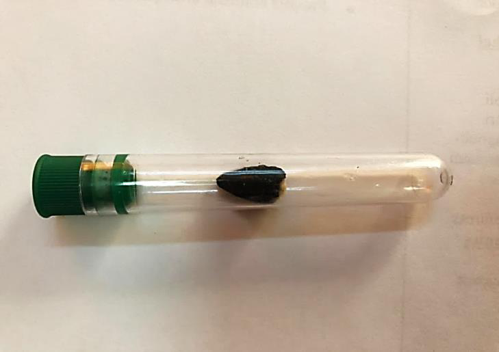 Figure 5: Foreign body (sunflower seed) removed.