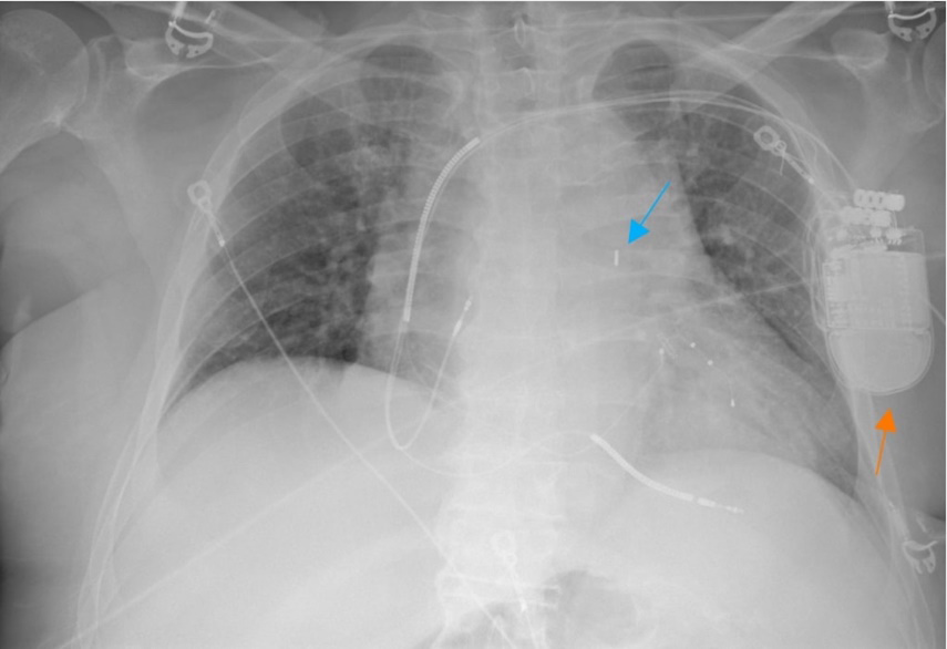 Figure 1: AP chest radiograph demonstrates left chest wall, left subclavian vein approach AICD (orange arrow) with leads terminate in right atrium, right ventricle, and coronary sinus. IABP (blue arrow) is also noted with distal metallic marker below the aortic knob.