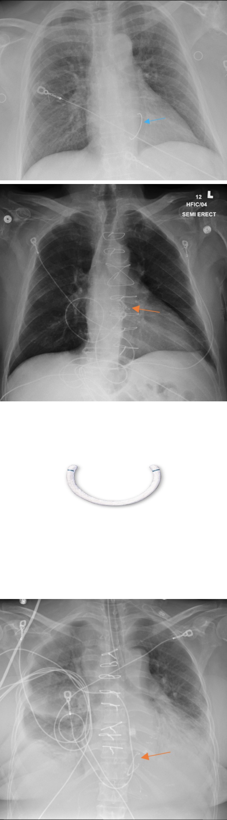 Figure 14: Lateral chest radiograph which demonstrates dual transcatheter valve replacement, in the aortic (orange arrow) and mitral (blue arrow) positioning.