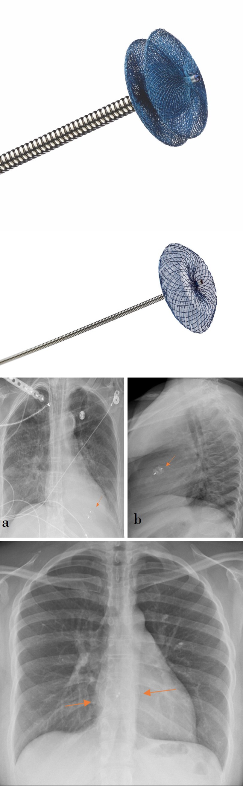 Figure 16: AP chest radiograph demonstrates TAVR migration, there are two valves; one pulled into the descending aorta (green arrow) and the other valve deployed into the aortic root (yellow arrow).