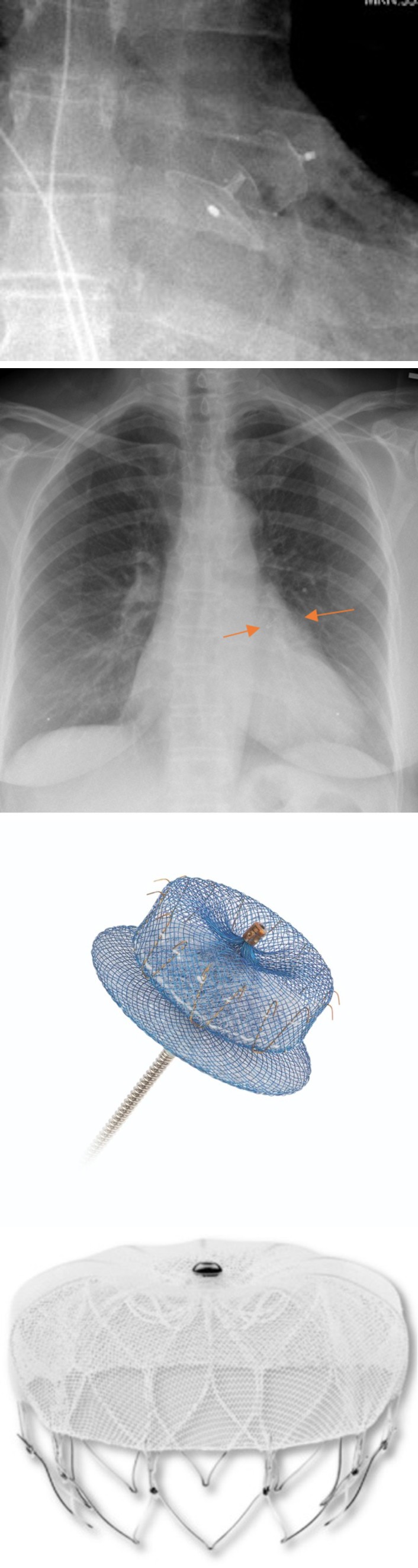 Figure 17: PA chest radiograph (a) shows the valve in valve TAVR (orange arrow).
