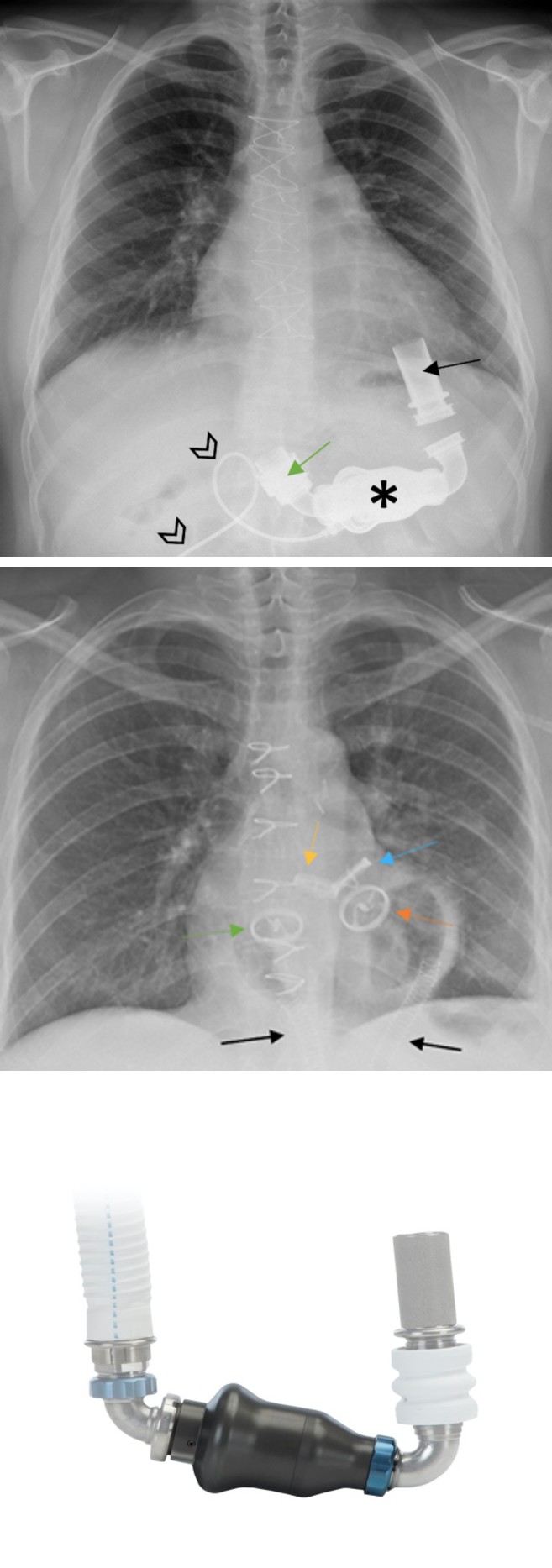 Figure 24: Frontal chest radiograph showing aortic stent graft placed in descending aorta (orange arrows).