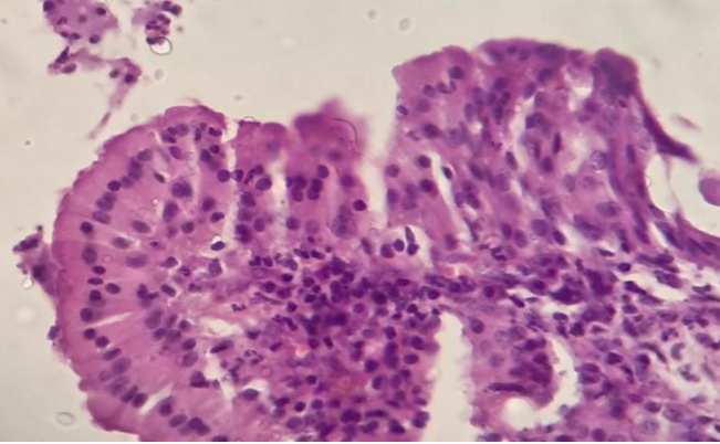 Figure 2: 40x shows oncocytic epithelium.