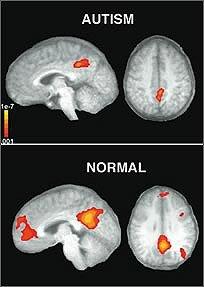 Figure 3: Functional MRI in normal and autistic individuals A study has showed many differences at neurotransmitters level during adolescence [8]. For instance, there are changes in the secretion and flow of Dopamine and there are peaks of Dopamine neural activity in the midbrain that slow down later in life. Studies have revealed huge difference in the balance between excitatory and inhibitory neurotransmission in adolescence compared to adults. The levels of GABA which is the chief inhibitory neurotransmitter have risen smoothly in the adolescent forebrains. The previously mentioned differences if impaired will result in many behavioural implications. At the functional level, fMRI images have shown massive differences in the functional activity in many areas of adolescent forebrains especially in these areas where emotional and sensory data are encrypting [9]. Behavioural development may be affected by maturity within different brain regions and between them and improvement in inter-neuronal coordination. Studies have shown direct relation between the increase in frontal white matter and the inhibition in the control performance [10]. Also, the development of white matter is found to be in direct relation to the improvement in the Factors like white matter enhancement, accelerated pruning of excitatory synapses and improvement in interneuron activity; together may promote better functional cortical coordination through adolescence. Some age-related electrophysiological studies have revealed clue of improvement in interneuron responses and better local coordination. Another study has shown the development of positive peak of about 300 ms when responding to a certain stimulus at the age of 13 [3]. These findings give another proof for the ongoing progression in the prefrontal cortical signal processing through adolescence. In vivo electrophysiological recording of the wave taken when electrodes placed in active behaving animals gives another evidence of neural activity in adolescence. Again, using techniques like fMRI in human samples and electrophysiological studies in animals, it became clearer that aspects of stimulated behaviours are different in various age groups. Regarding the total brain volume, it has been found that it is atypical in autistics in the form of high prevalence of macrocephaly (unusually large sized head; AJM, 2006) coexisted with larger brain volume and / or accelerated growth of brain compared to static total brain volume till the age of 13 years that found to decrease during early years of adulthood (Neuroimage, 2007). This atypical brain growth in childhood is assumed due to the expansion of the total white matter compared to grey matter (Brain, 2003). White matter continues to increase in terms of volume in adolescence while grey matter peaked before adolescence reached [11]. Some studies suggest that over all brain size in adulthood is unchanged in autistic individuals without intellectual impairment [12].