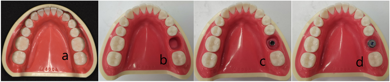 Figure 1: (a) Mandibular dentition model. (b) Gingival contour is shown. (c) Experimental implant was inserted into the mandibular first molar. (d) Scanning abutment was installed in mandibular first molar.