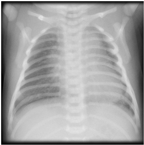 Figure 5: CXR- TTNB.