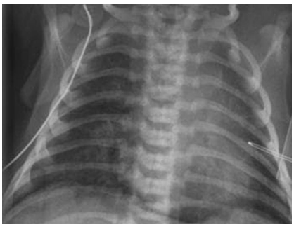 Figure 7: CXR –MAS.
