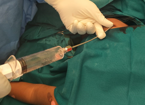 Figure 2: Method of lipoaspiration from abdomen using a cannula and syringe with luer lock mechanism.