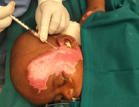 Figure 3: Injection of lipoaspirate into 2nd degree deep scald burn.