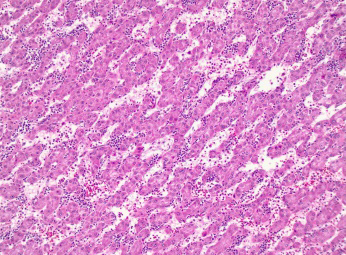 Figure 2: Hepatocellular adenoma delineating mildly thickened hepatocyte cell plates surrounded by uninvolved hepatic parenchyma. Foci of steatosis are discerned. Cytological atypia or infiltration of portal tracts appears absent [6].