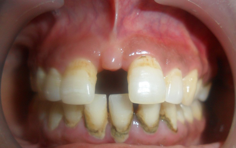 Figure 1: Intraoral photograph of the mother showing presence of maxillary midline diastema and existence of prominent high upper labial frenum attachment.