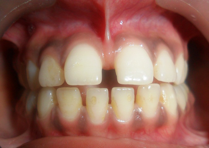 Figure 2: Photograph showing presence of maxillary midline diastema as well as prominent high labial frenum attachment in daughter showing familial pattern.