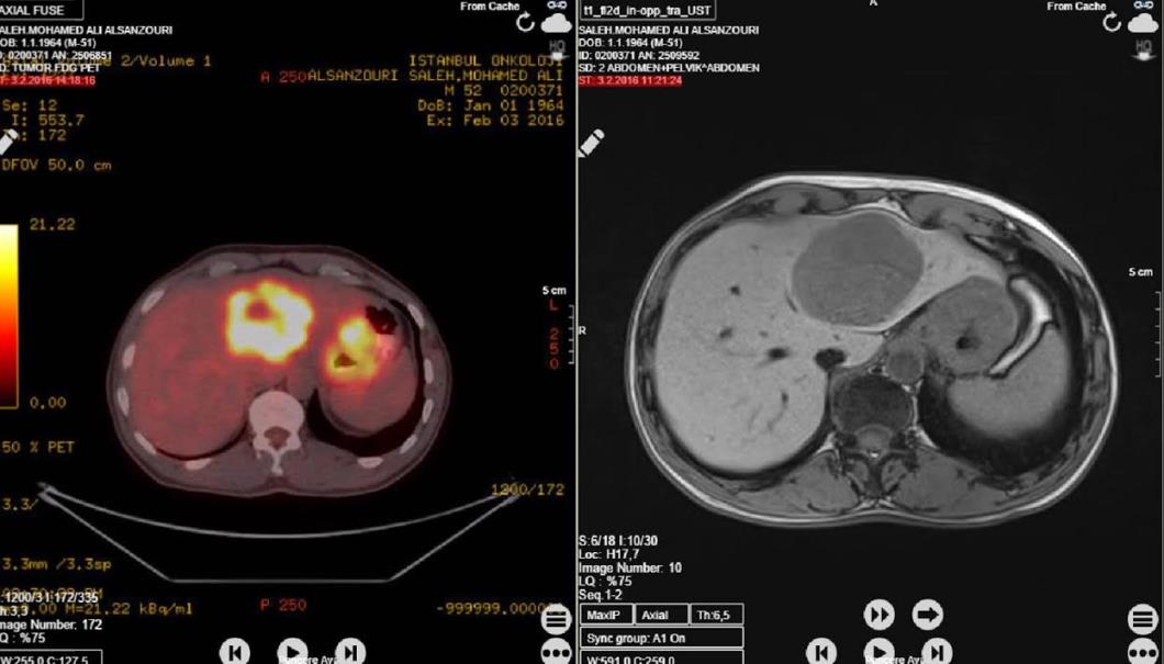 Figure 1: Large metastatic mass in the liver in CT findings.