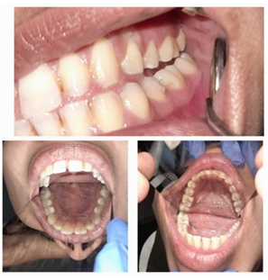 Figure 2: Intraoral Examination.