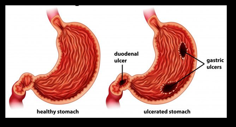 Figure 1: Peptic Ulcer.