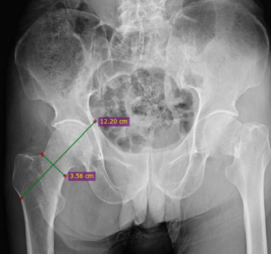 Figure 1: Measurement of Hip Axis Length.