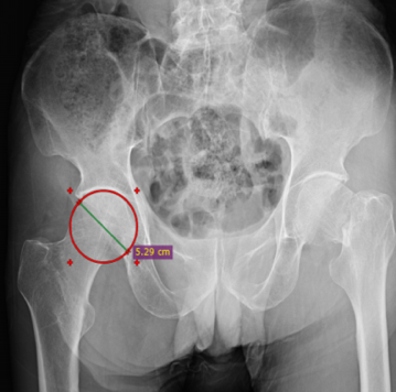 Figure 4: Measurement of Femoral Head Diameter.