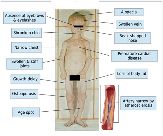 Figure 2: Symptoms of Progeria Syndrome.