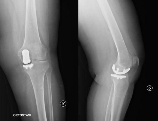 Figure 7: UKA medial right knee radiographic image.