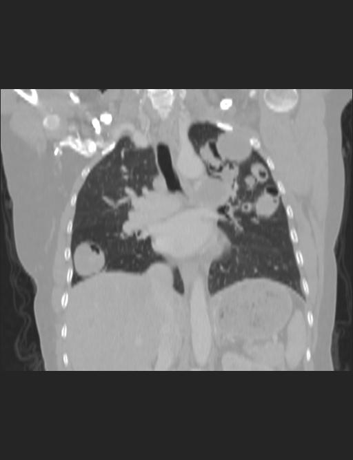 Figure 1: In addition, a hydatid cyst of a similar nature was observed in the heart and pericardium Figure 2. On CT, cyst hydatid cysts were observed to have low densities and type 1 character. The most interesting one, and the more uncommon one, is that the hydatid cyst has infected the left pulmonary artery Figure 3. Possible source of lesions in the lung. This case is a rare hydatid cyst with heart, lung and pulmonary artery,