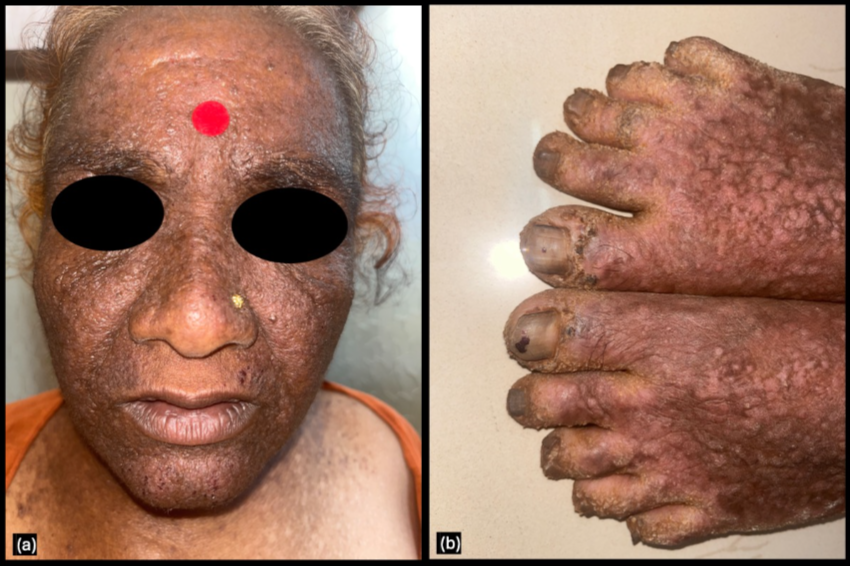 Figure 1: A 60-year-old female presented with skin-coloured and hyperpigmented, firm, slightly greasy papules with a cobblestone appearance over the (a) face and (b) dorsa of hands and feet.