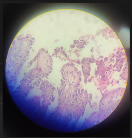 Figure 2: Histopathological examination revealed parakeratosis, papillomatosis, and suprabasal acantholysis and clefts with corps ronds in the granular layer. H&E staining, 40x.