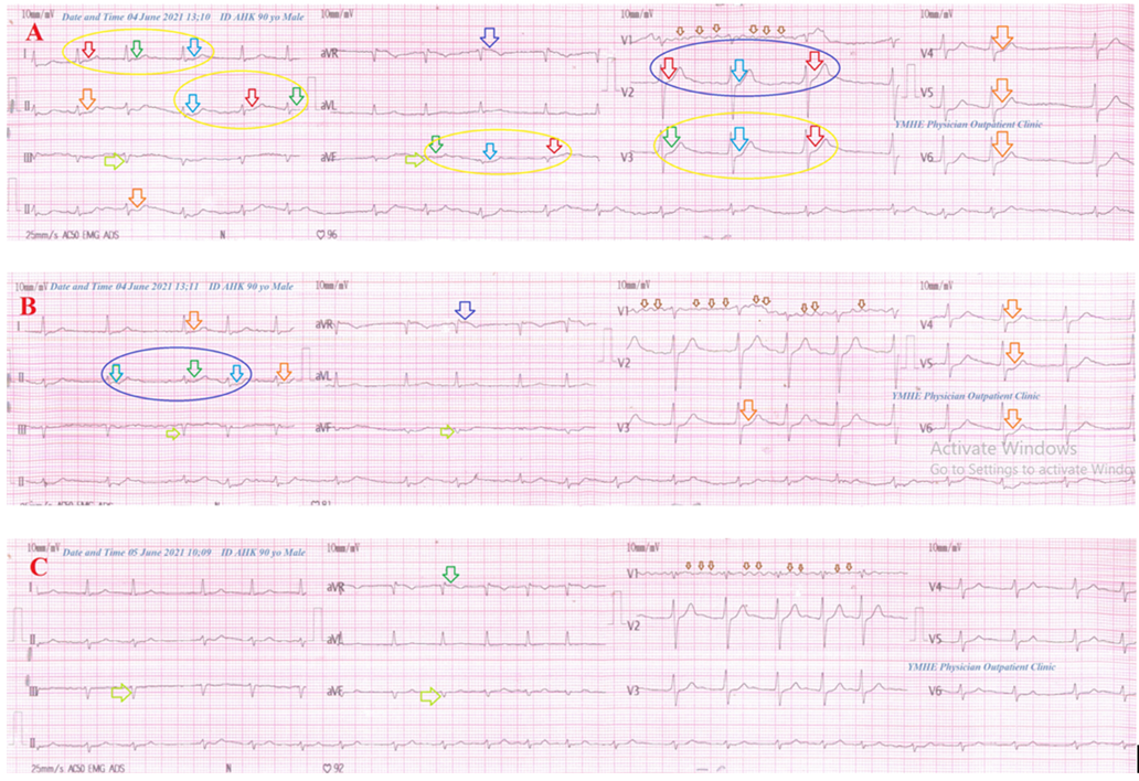Figure 1: Serial ECG tracings; A: tracing was done on the initial presentation to the POC showing AF (of VR 77; small brown arrows), with ST-segment depression in the inferior and anterolateral leads (orange arrows; II, III, and V4-6), ST-segment elevation (dark blue arrow; aVR), evidence of LAD, Wavy triple ECG sign (Yasser’s sign; I, II, aVF, and V3, light blue, red, and green arrows in yellow circle) Wavy double ECG sign (Yasser’s sign; V2, light blue and red arrows in blue circle) and pathological Q waves in inferior leads (lime arrows; III and aVF). B: tracing was taken within 1 minute of the above ECG tracing showing AF (of VR 83; small brown arrows) with ST-segment depression in the inferior and anterolateral leads (orange arrows; I, II, and V3-6), ST-segment elevation (dark blue arrow; aVR), evidence of LAD, Wavy double ECG sign (Yasser’s sign; II, light blue and green arrows), and pathological Q waves in inferior leads (lime arrows; III and aVF). C: tracing was taken within 24 hours of the above ECG tracing after the initial treatment showing AF (of VR 97; small brown arrows) with normalization of ST- segment elevation (green arrow; aVR), normalization of ST-segment depression, the disappearance of Wavy triple ECG sign, the disappearance of Wavy double ECG sign, and pathological Q waves in inferior leads (lime arrows; III and aVF).