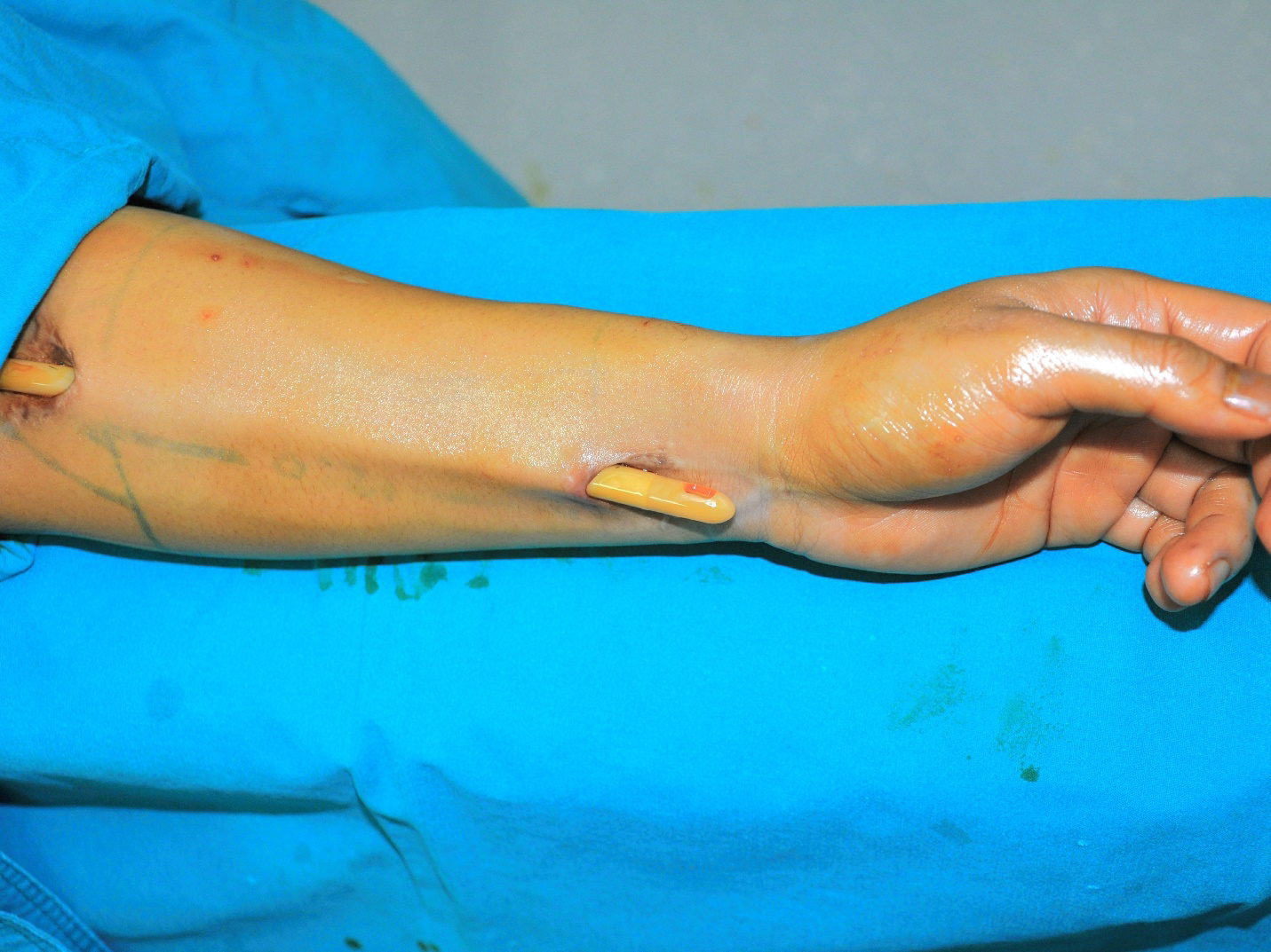 Figure 1: Prefabricated urethra on the left forearm at 6 months postoperative.