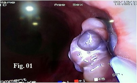 Figure 1: Colonoscopy was Performed which Revealed Polypoidal Growth in the Anorectal Region with Infiltration.