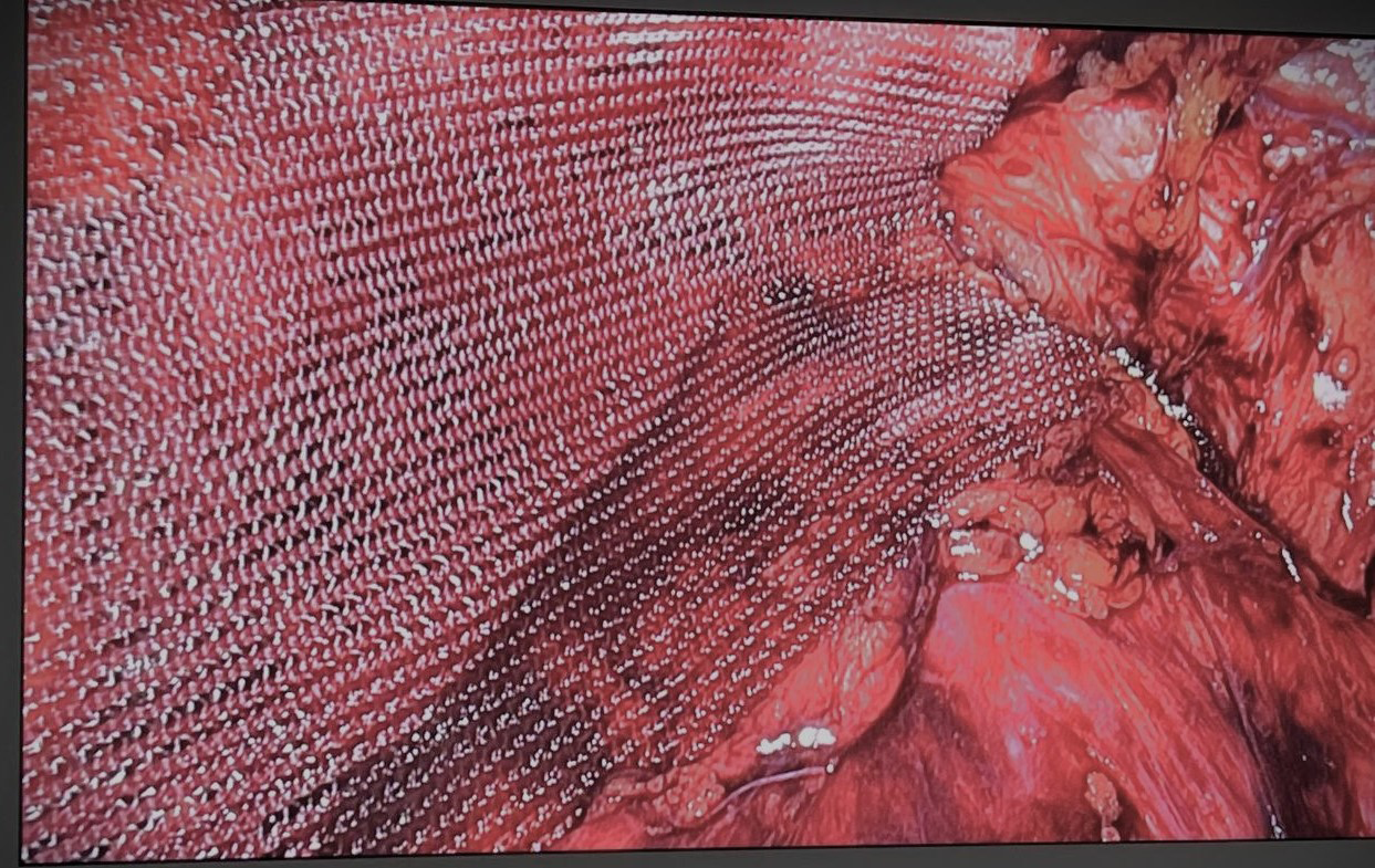 Figure 1: Mesh Placement in TEP.