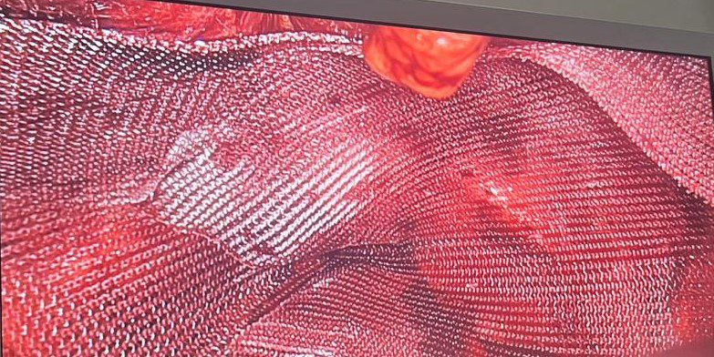 Figure 2: Bilateral Inguinal Hernias: Overlapping of Mesh in the Midline.