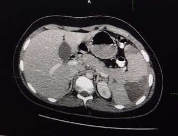 Figure 1: Axial and sagittal CT images post contrast showing enlarged bulky spleen with multiple wedge-shaped peripherals based hypodense areas suggestive of splenic infarcts.