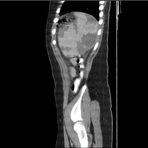 Figure 2: Splenic infarcts are also resolved with hyperechoic scars the largest one measuring 1.6 × 0.8 cm only.
