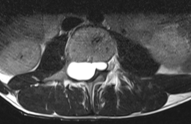 Figure 1: Preoperative sagital T1 and T2-weighted spinal magnetic resonance (MR) images showing cystic lesion located in extradural space.
