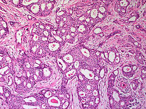 Figure 2: Invasive cribriform carcinoma expounding a distinct cribriform pattern composed of islands and nests of miniature, mildly pleomorphic epithelial cells circumscribed by a desmoplastic stroma [6].