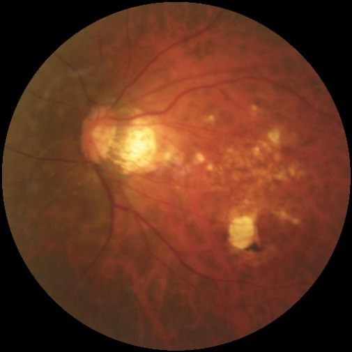 Figure 1: Example of training CFP for pathological myopia.