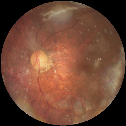 Figure 2: Example of training CFP for glaucoma.