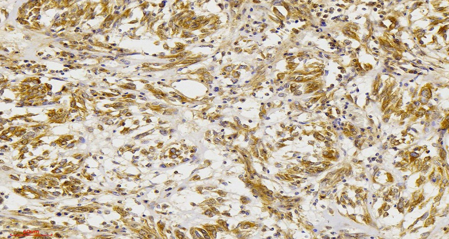 Figure 3: Photomicrograph Showing Strong VEGF Score 3+ in Diffuse-Type Gastric Adenocarcinoma (X200).