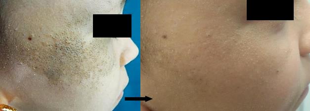 Figure 4: Microscopic features by Hematoxylin-Eosin staining with magnification power (x100) for the left photo and (x400) on the right photo.