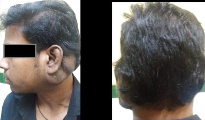 Figure 1: Left sided neck swelling.