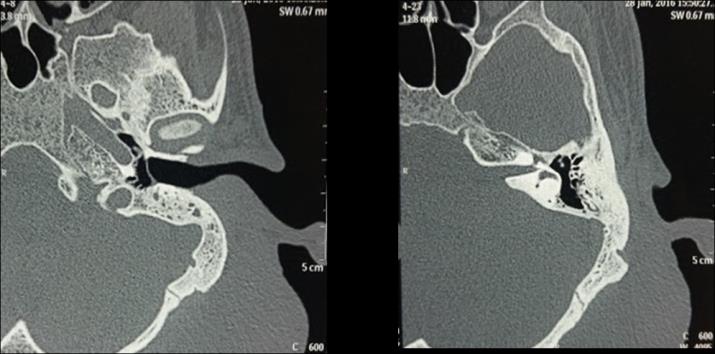 Figure 2: CT showing abnormal soft tissue at the skull base on the left side, extending from post auricular region and reaching caudally into the upper cervical region with loss of fat planes between the lesion and parotid gland and also with the sternocleidomastoid muscle. MRI was done for better soft tissue delineation. It revealed a large (9cm X 7cm X 4cm) T2 heterogeneously hyper intense lesion in the left peri-parotid region. There was loss of fat planes between the lesion and parotid gland with infiltration of the superficial lobe. There was no evidence of flow voids or calcification within the lesion. The initial fine needle aspiration cytology was reported as lymphangioma. Skin biopsy showed a dense diffuse and nodular infiltrate of lymphocytes and histiocytoid cells involving the whole of reticular dermis and extending to sub cut is with most of nodules showing formation of lymphoid follicles and few eosinophils scattered within the infiltrate. These findings were consistent with a diagnosis of Kimura’s disease. Accordingly, the patient was started on high dose corticosteroids (60 mg of oral prednisolone) for two months with gradual tapering thereafter. The response was excellent with complete disappearance of lesions (Figure 3) and normalisation of serum eosinophil and IgE levels. Now, the patient is on small dose of prednisolone 7.5 mg per day since two months and there has been no recurrence.