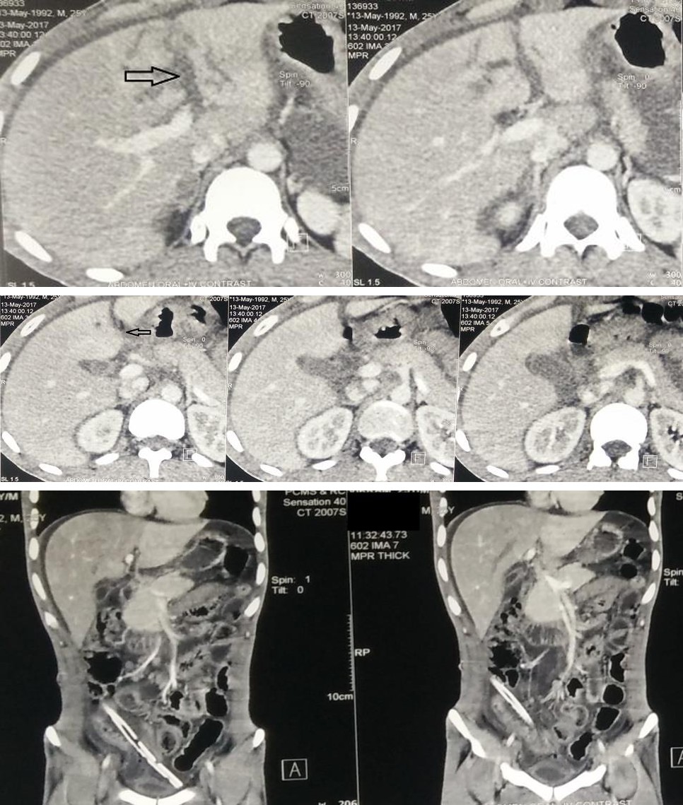Figure 1: Initial CECT abdomen showing lacerated 4A segment of liver (black arrow) around the left portal vein.