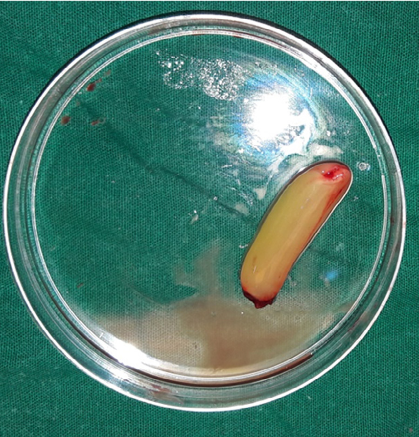 Figure 3: Platelet rich fibrin matrix.