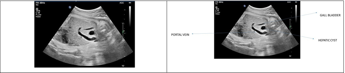 Figure 1: Suprarenal mass.