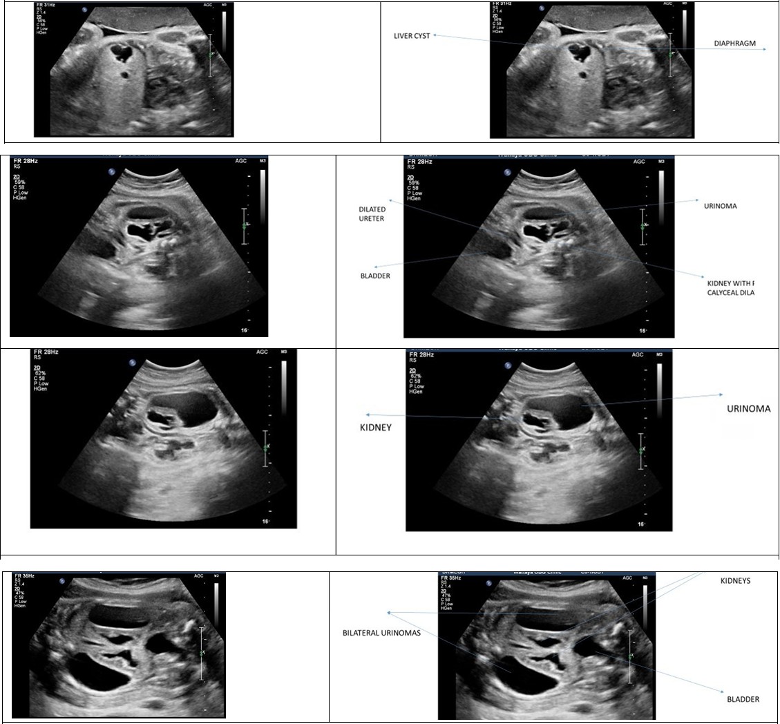 Figure 2: Dilated rectum, renal pelvis dilatation.