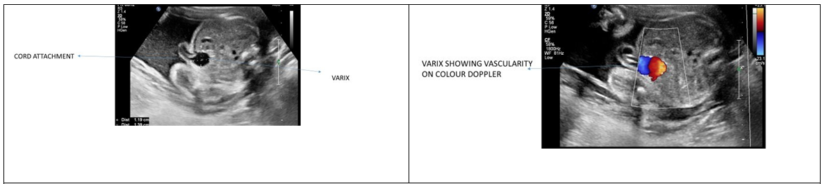 Figure 7: Umbilical varix.