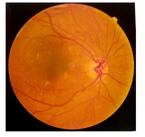 Figure 1: Clinically Significant Macular Edema (CSME) right eye.
